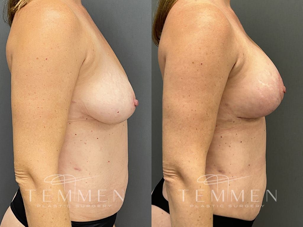 Breast Augmentation With Lift Before & After