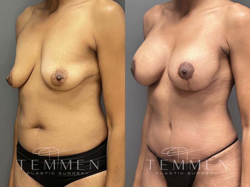 Breast Augmentation With Lift Before & After