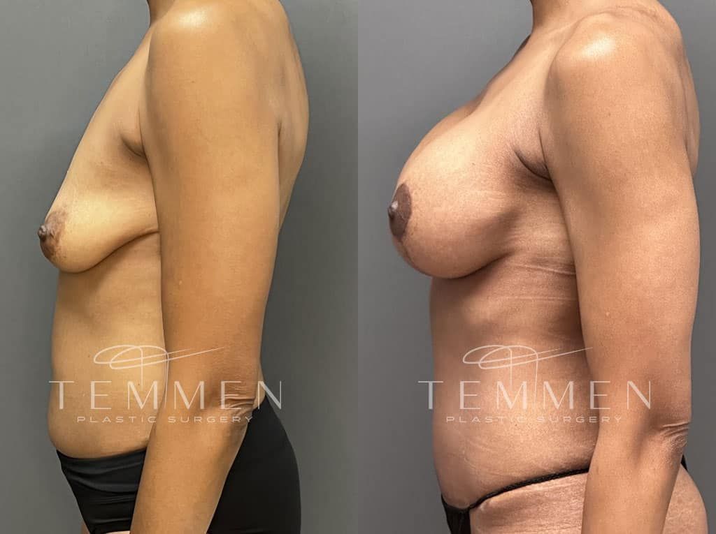 Breast Augmentation With Lift Before & After