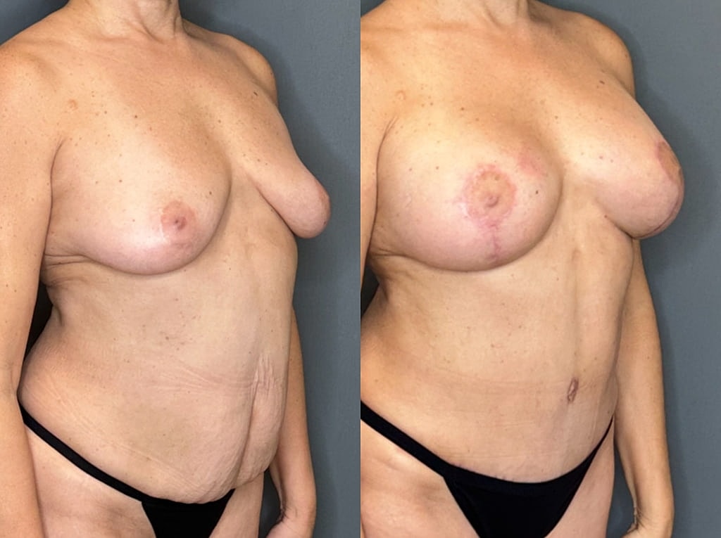 Breast Augmentation With Lift Before & After
