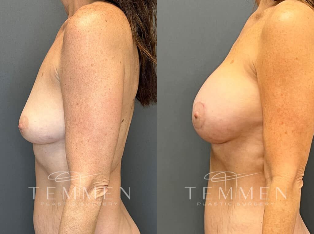 Breast Augmentation With Lift Before & After