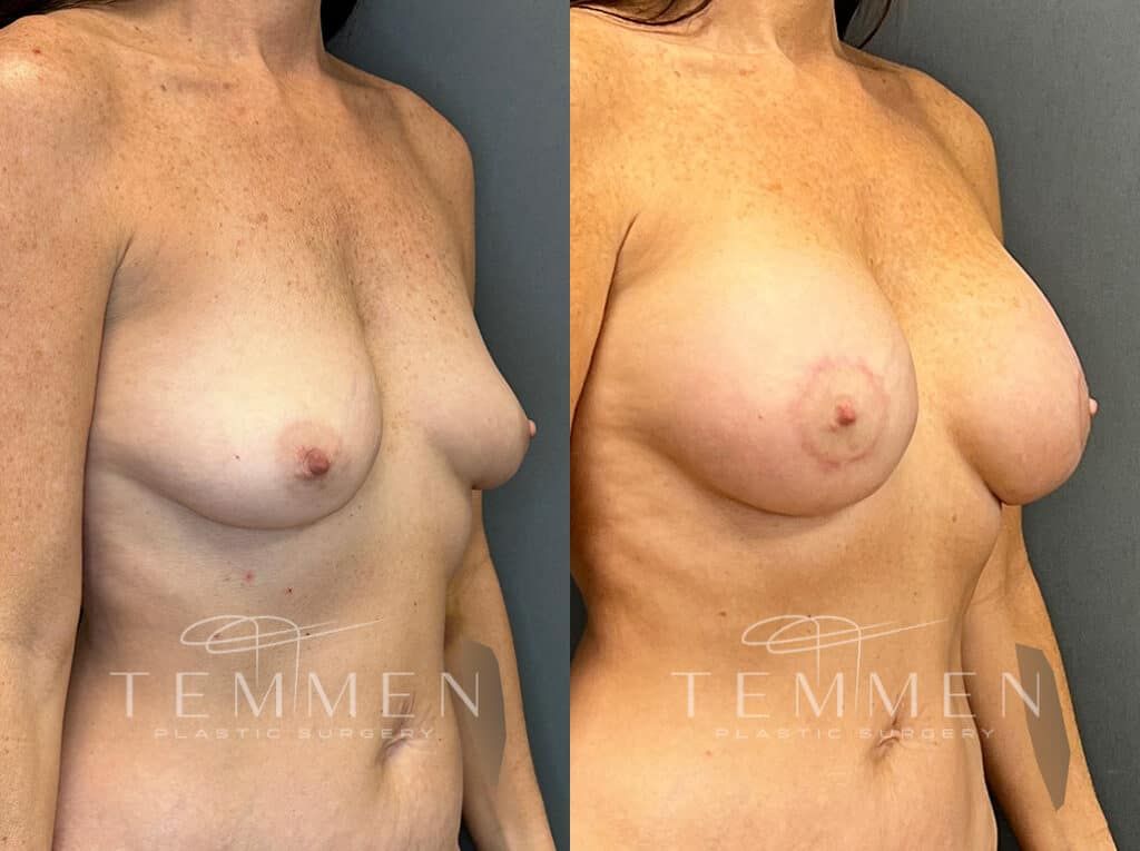 Breast Augmentation With Lift Before & After