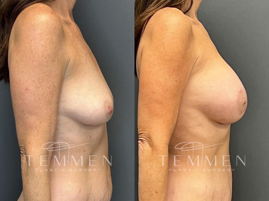 Breast Augmentation With Lift Before & After