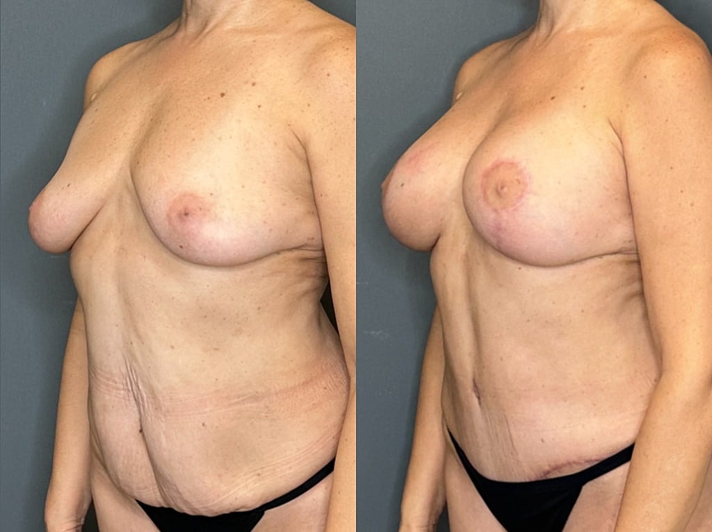 Breast Augmentation With Lift Before & After