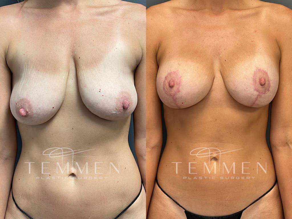 Breast Augmentation With Lift Before & After