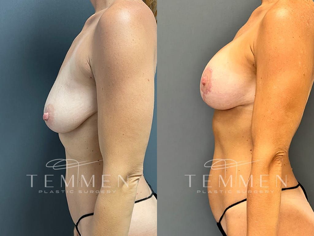Breast Augmentation With Lift Before & After