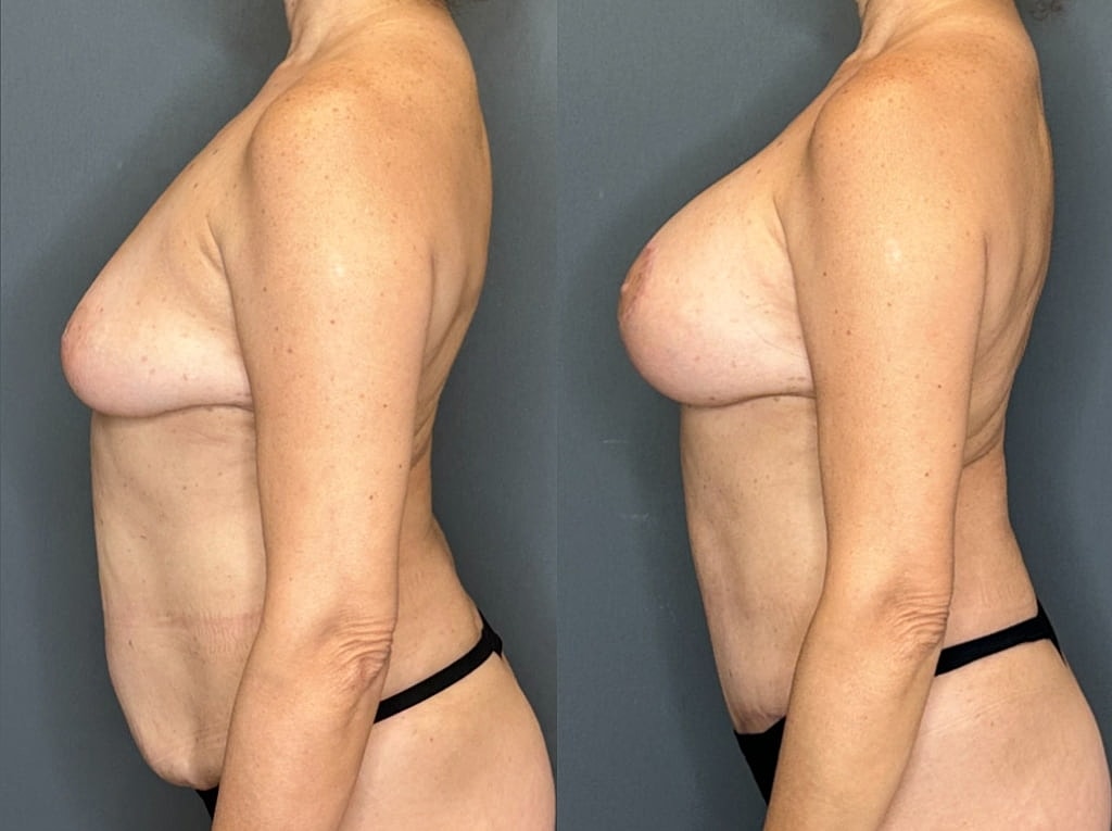 Breast Augmentation With Lift Before & After
