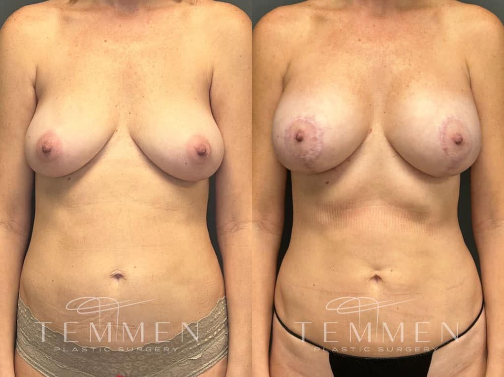 Breast Augmentation With Lift Before & After