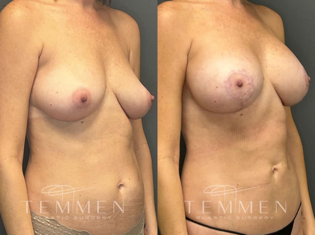 Breast Augmentation With Lift Before & After
