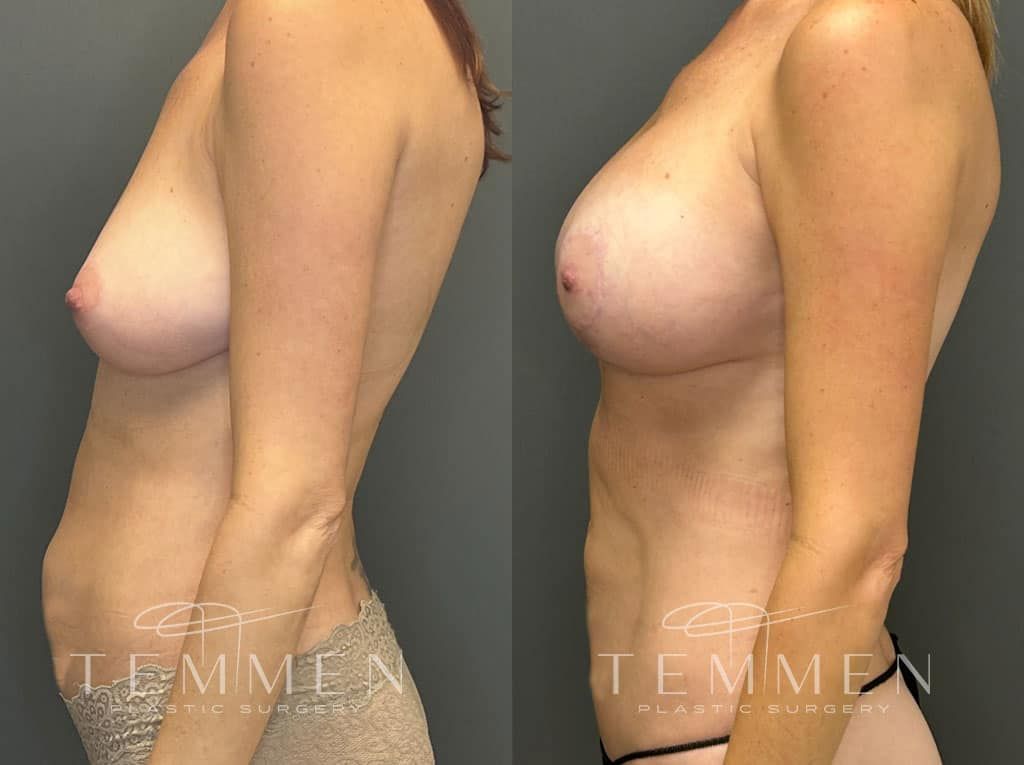 Breast Augmentation With Lift Before & After