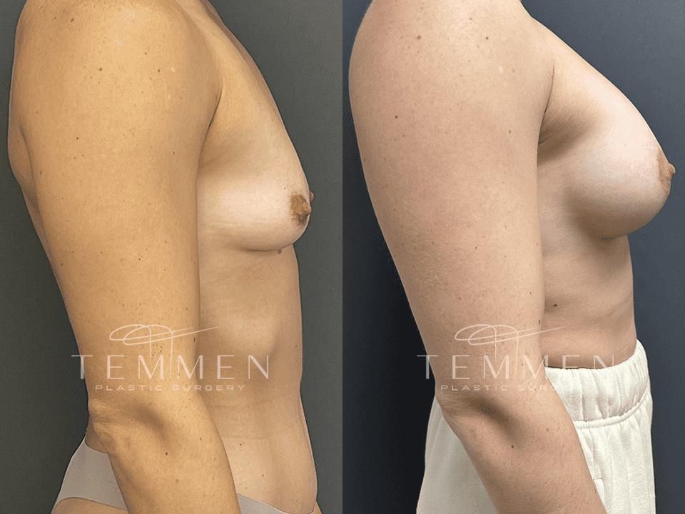Breast Augmentation With Lift Before & After