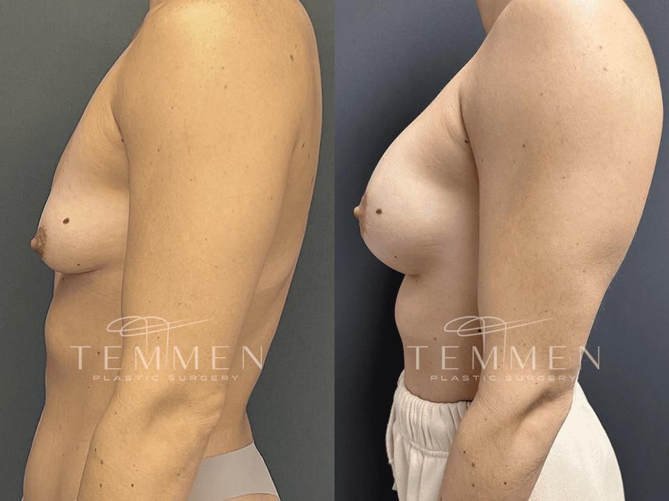 Breast Augmentation With Lift Before & After