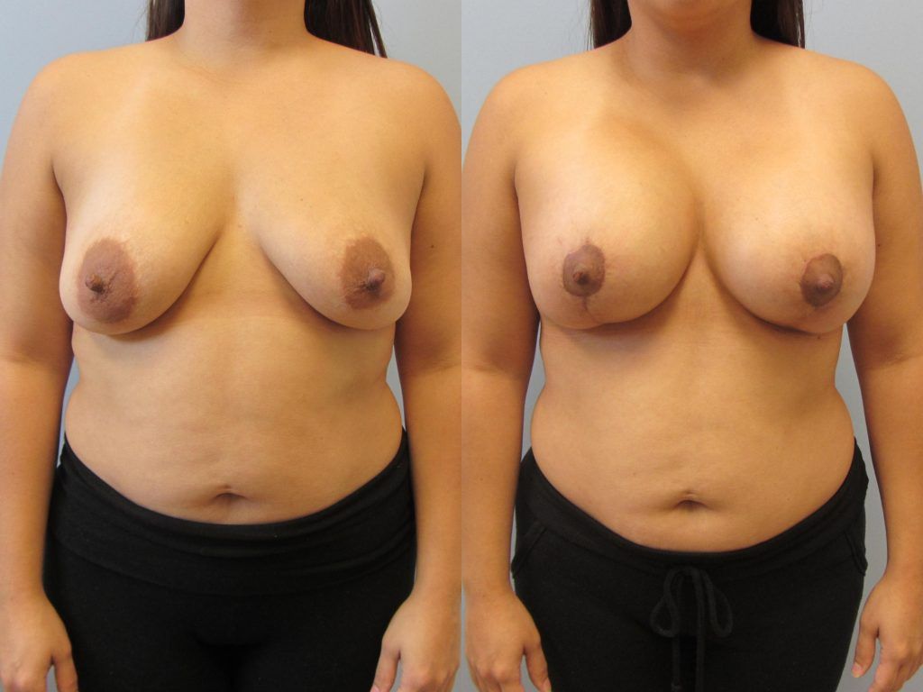 Breast Augmentation With Lift Before & After