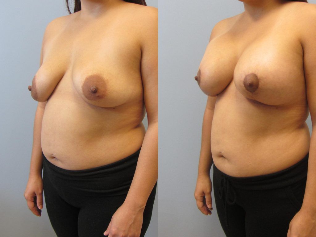 Breast Augmentation With Lift Before & After