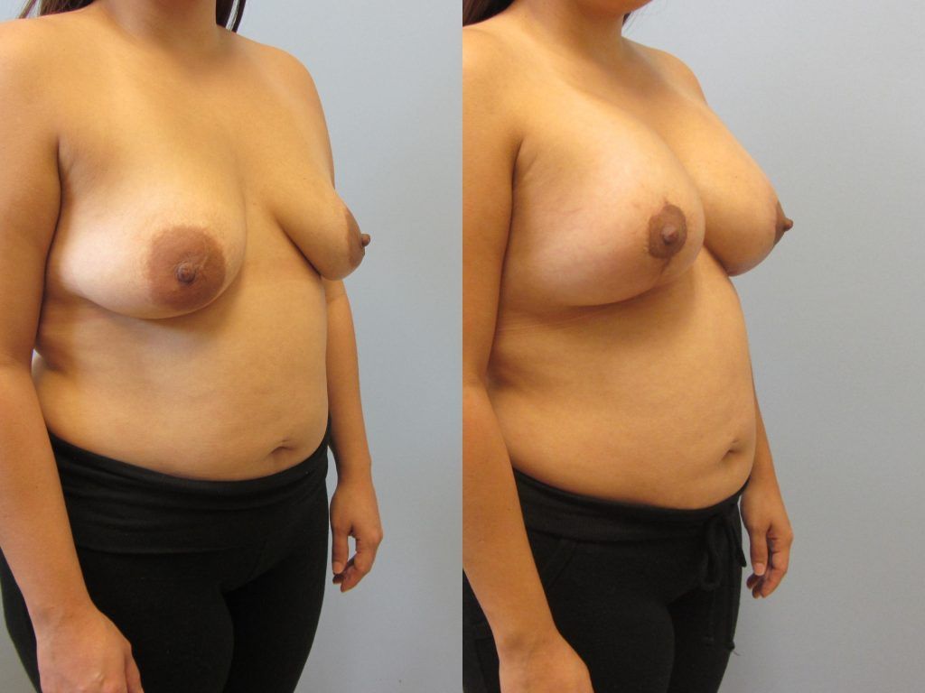Breast Augmentation With Lift Before & After