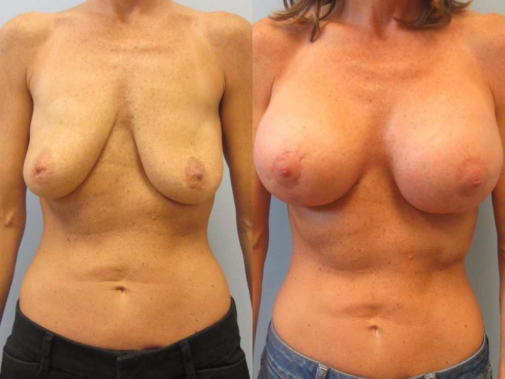 Breast Augmentation With Lift Before & After