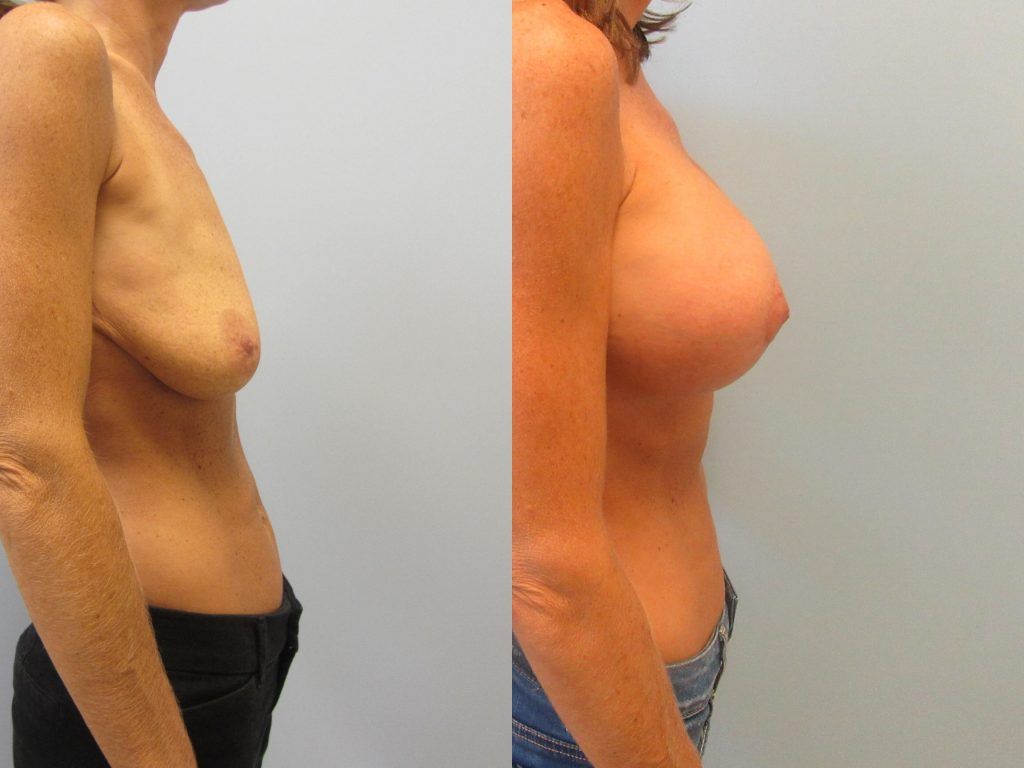Breast Augmentation With Lift Before & After