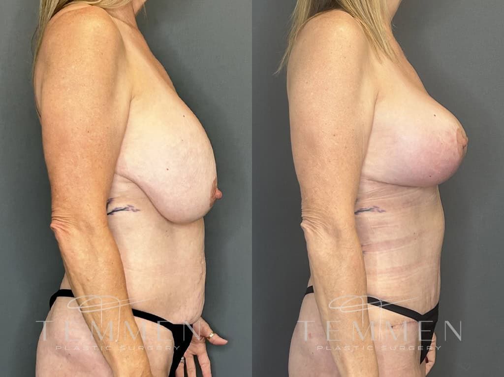 Breast Augmentation With Lift Before & After