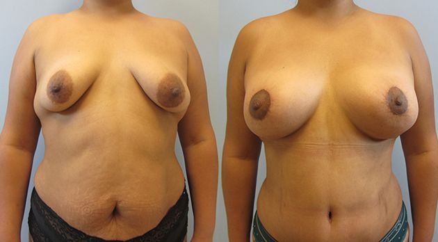 Breast Augmentation With Lift Before & After