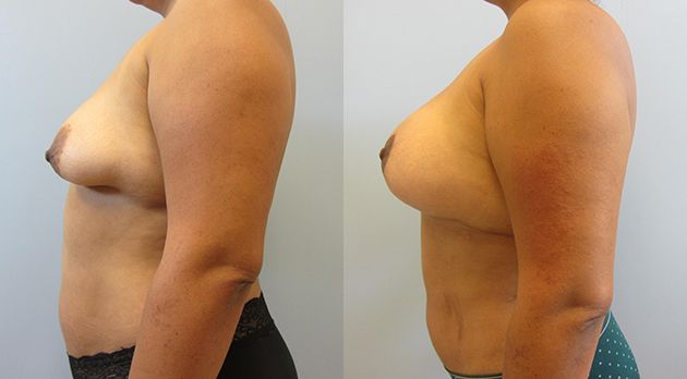Breast Augmentation With Lift Before & After