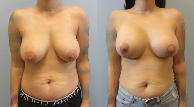 Breast Augmentation With Lift Before & After