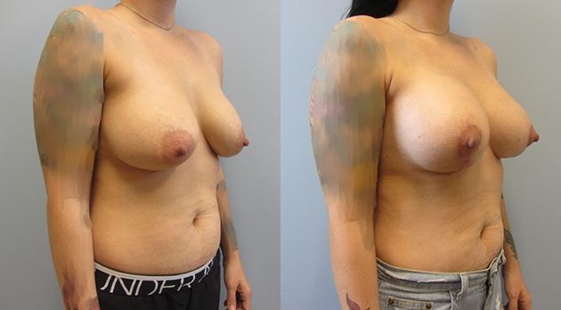 Breast Augmentation With Lift Before & After