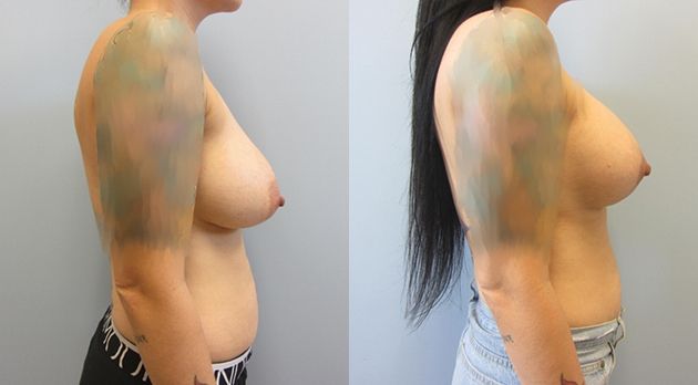 Breast Augmentation With Lift Before & After