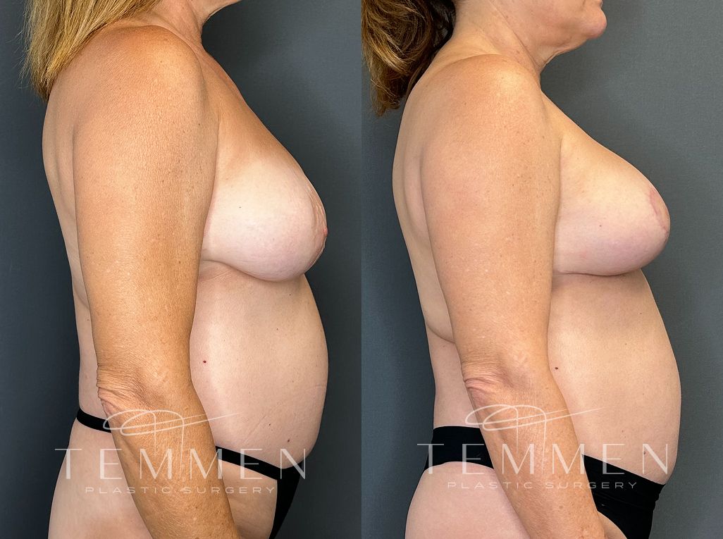 Breast Augmentation With Lift Before & After