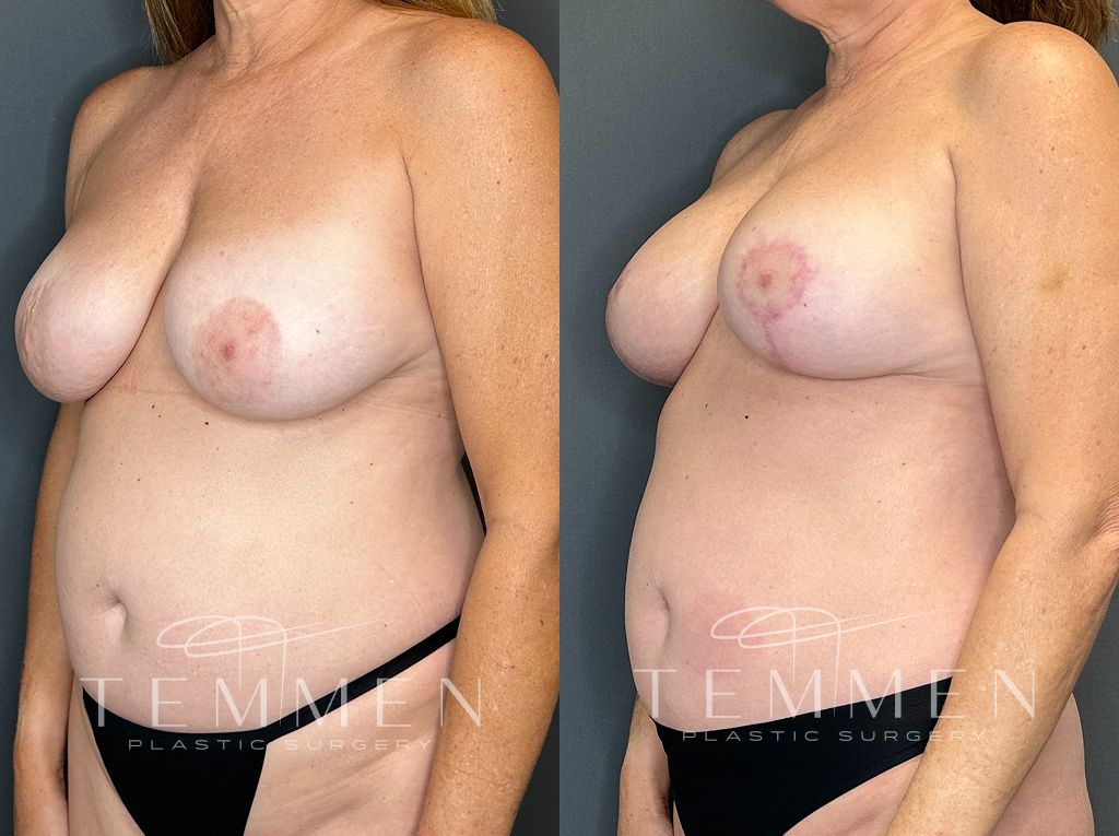 Breast Augmentation With Lift Before & After