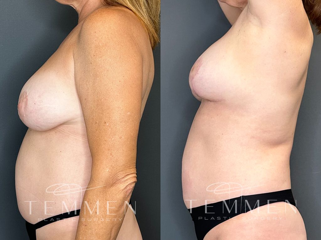 Breast Augmentation With Lift Before & After