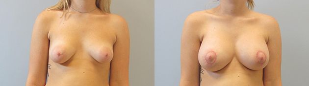 Breast Augmentation With Lift Before & After