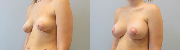 Breast Augmentation With Lift Before & After