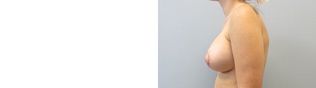 Breast Augmentation With Lift Before & After