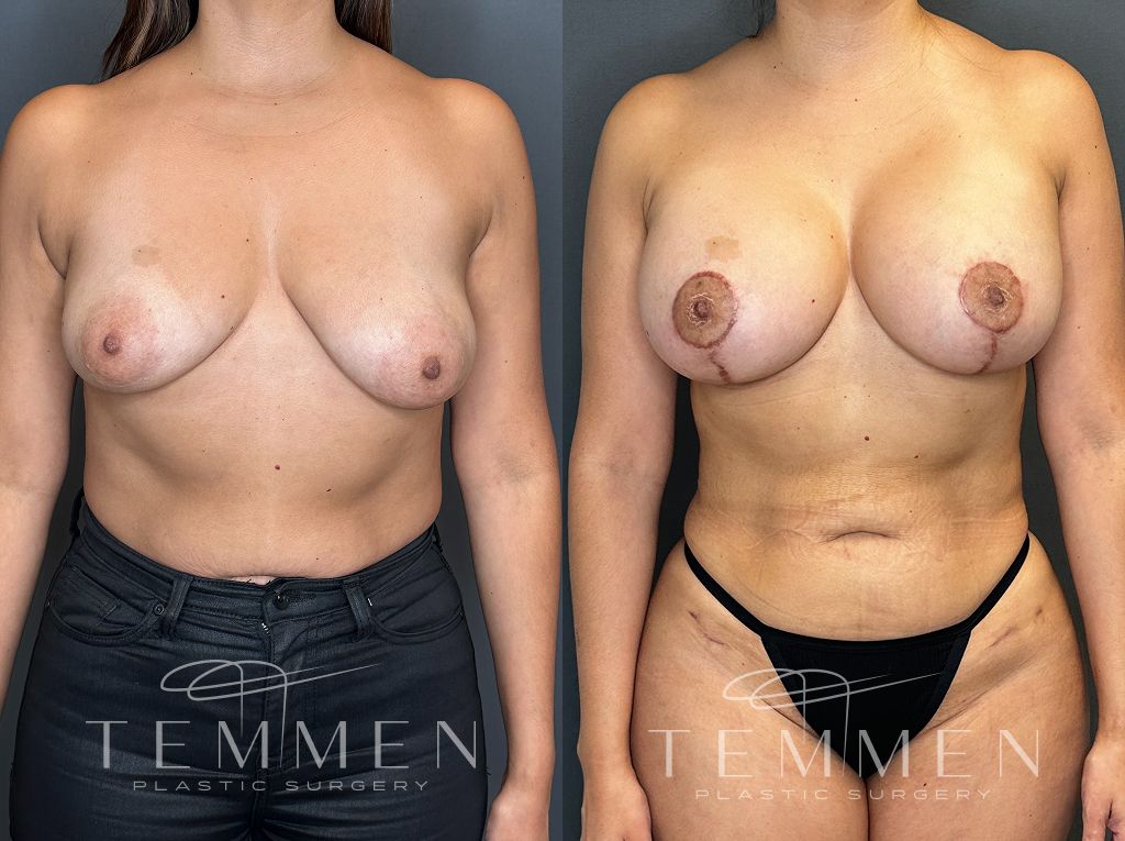 Breast Augmentation With Lift Before & After