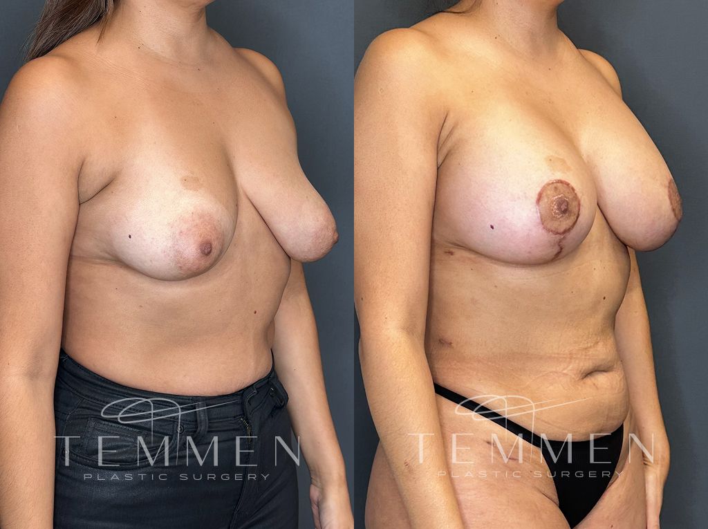 Breast Augmentation With Lift Before & After