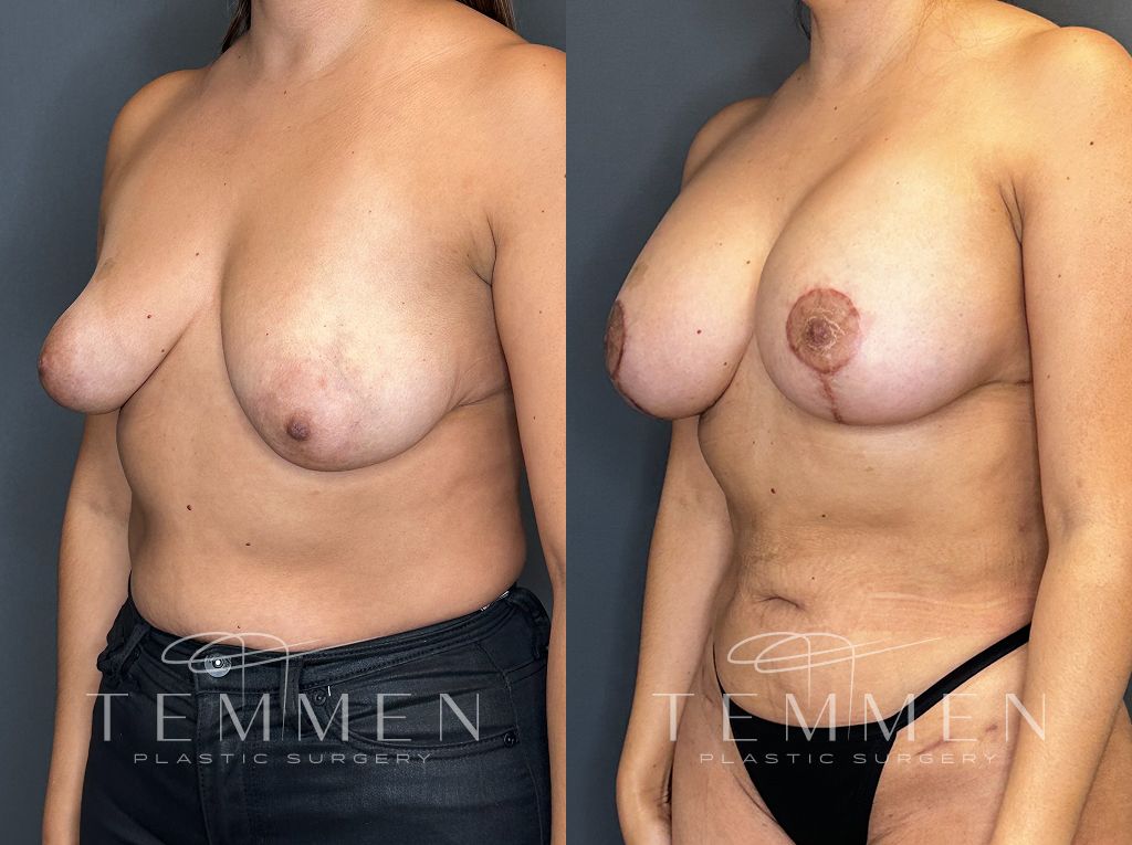 Breast Augmentation With Lift Before & After