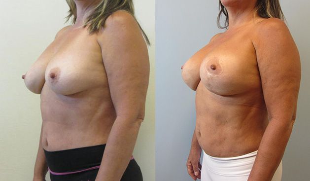 Breast Augmentation With Lift Before & After