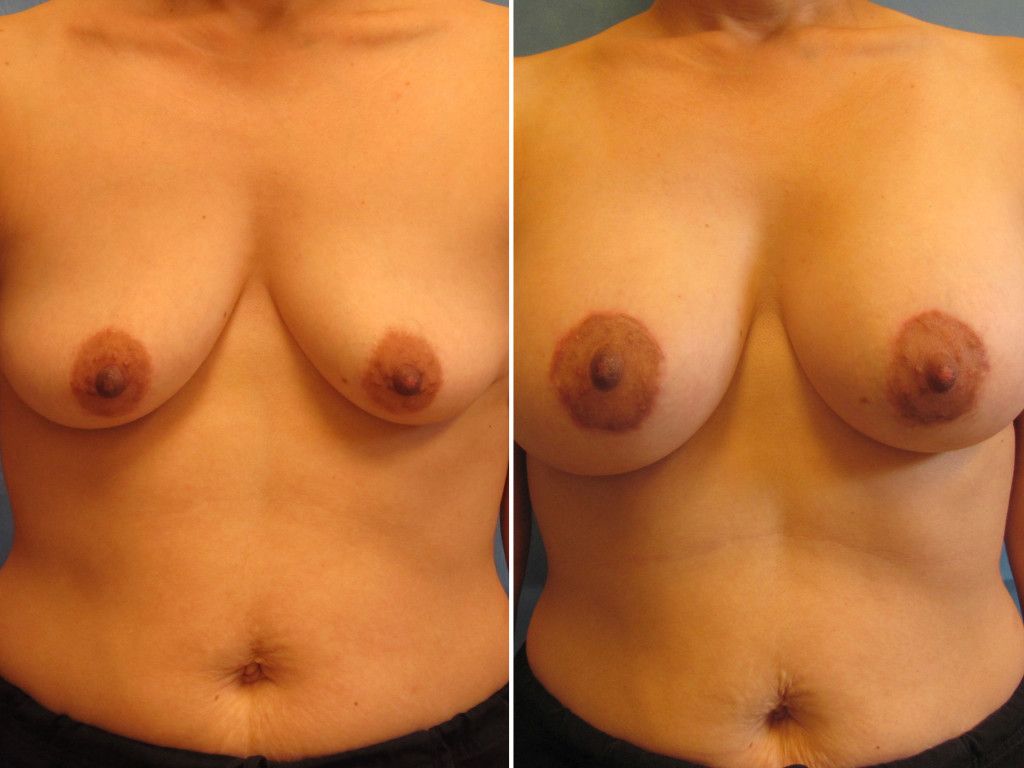 Breast Augmentation With Lift Before & After