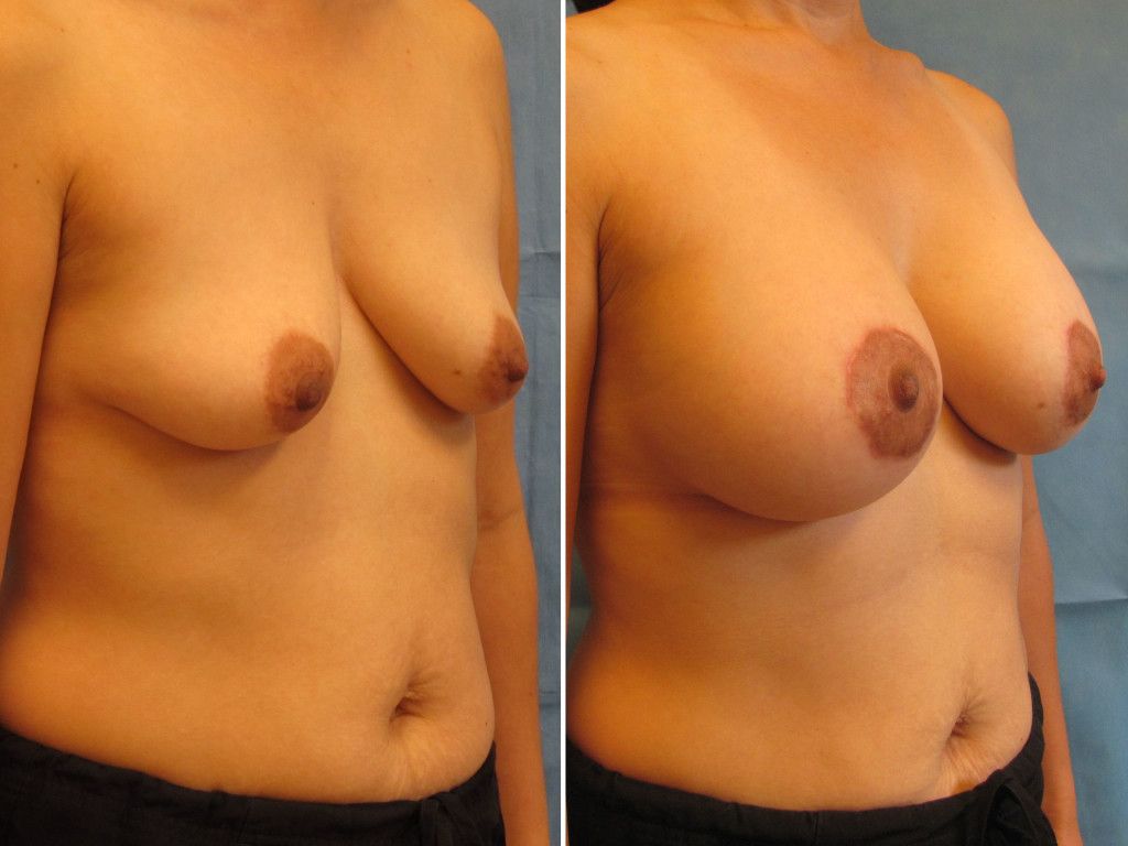 Breast Augmentation With Lift Before & After