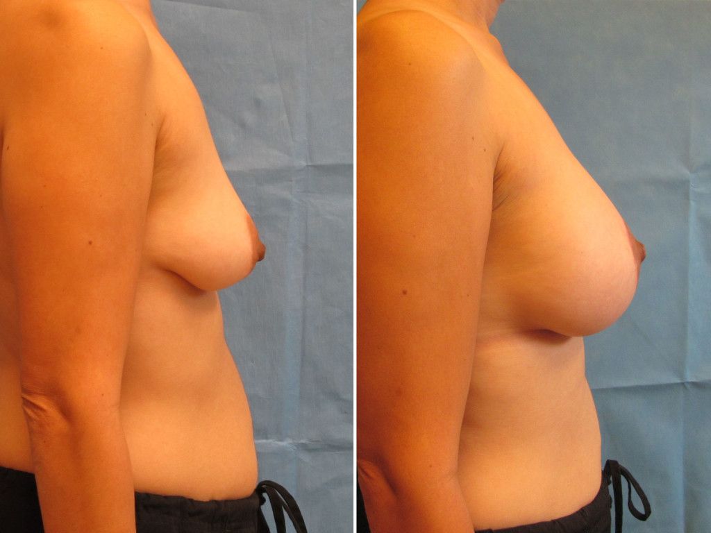 Breast Augmentation With Lift Before & After