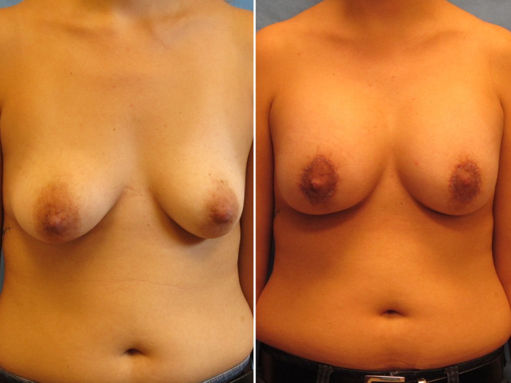 Breast Augmentation With Lift Before & After