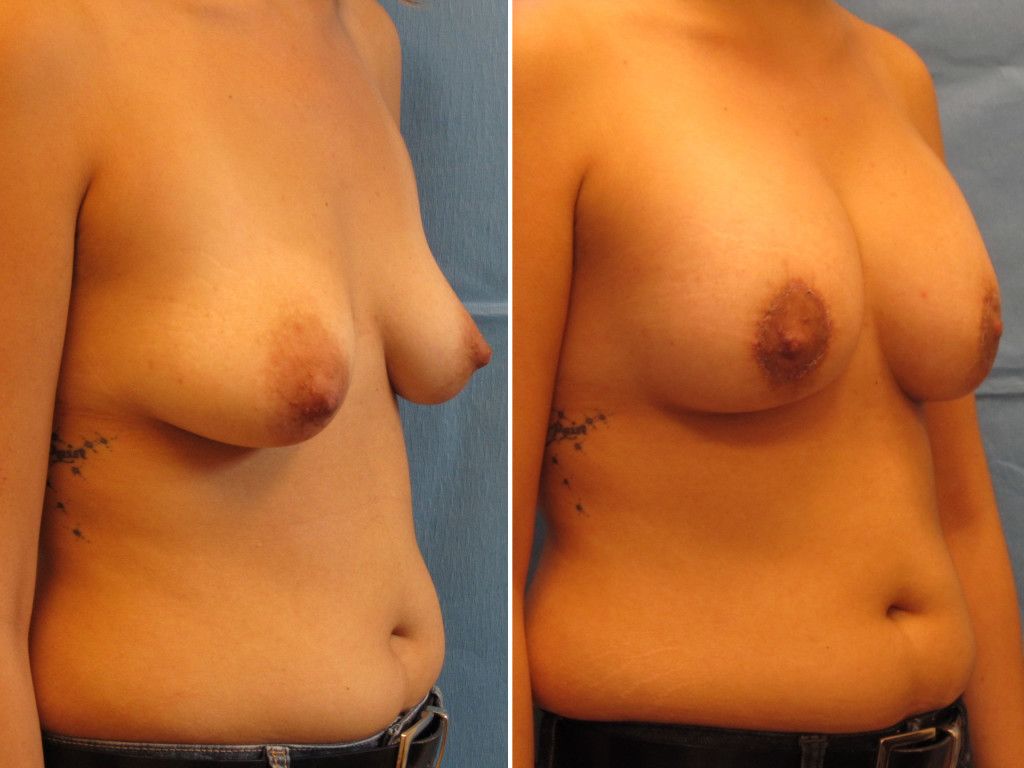 Breast Augmentation With Lift Before & After