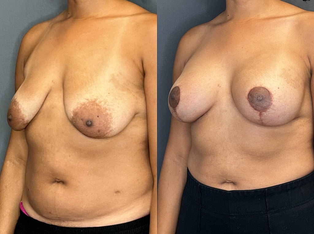 Breast Augmentation With Lift Before & After