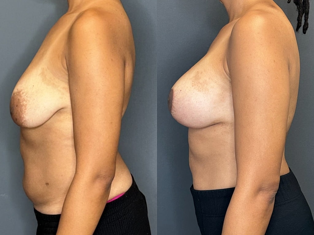 Breast Augmentation With Lift Before & After