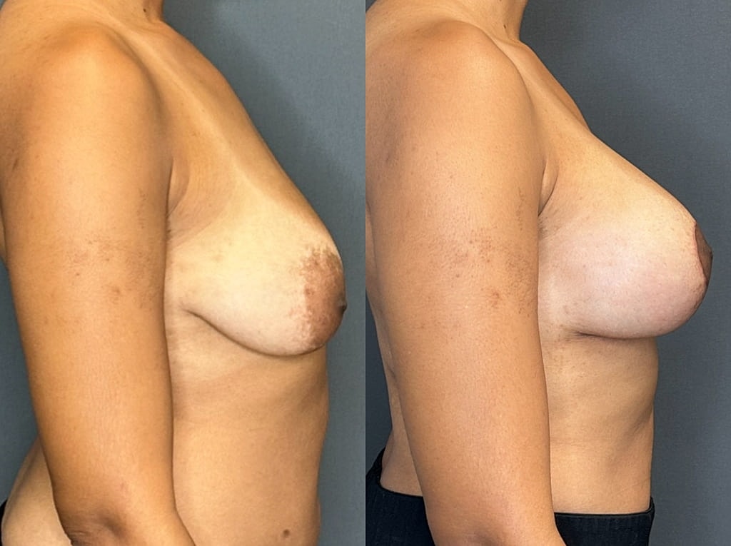 Breast Augmentation With Lift Before & After