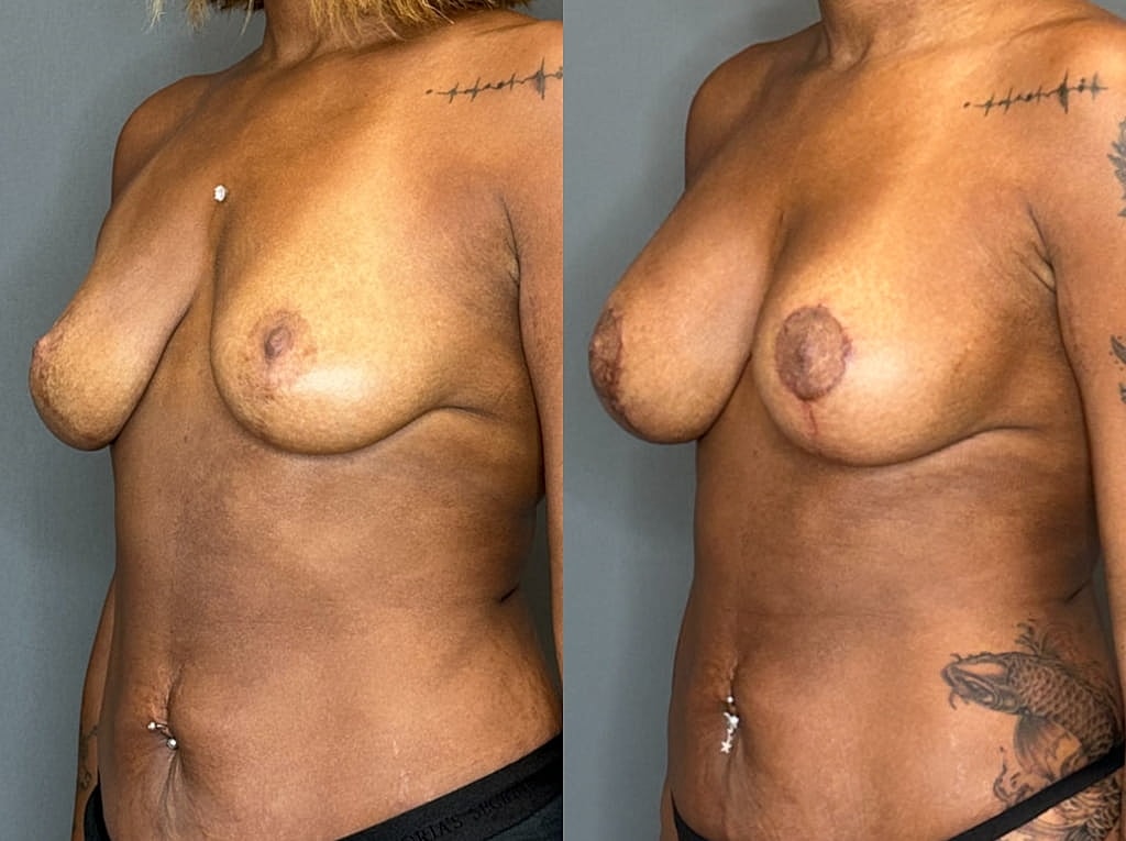 Breast Augmentation With Lift Before & After