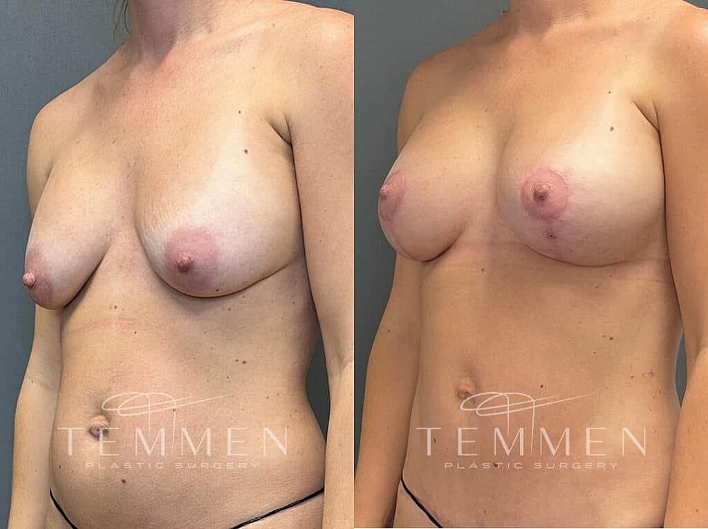 Breast Augmentation With Lift Before & After