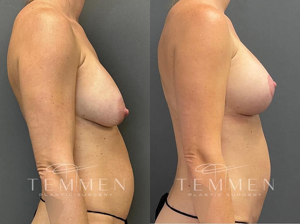 Breast Augmentation With Lift Before & After