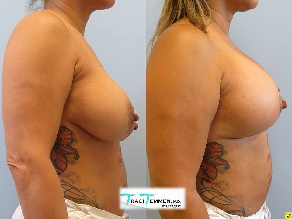 Breast Augmentation With Lift Before & After
