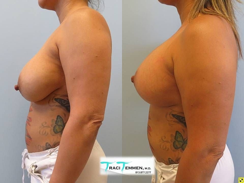 Breast Augmentation With Lift Before & After